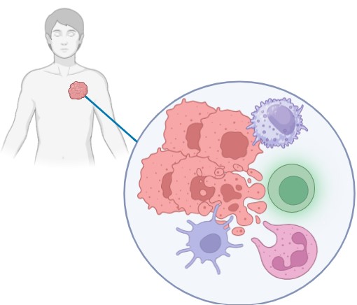 AdCab injected directly into a patient's tumor turns tumor cells into biofactories producing a PD-L1 targeted peptide